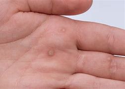 Image result for Blood Warts Skin