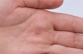 Image result for Common Skin Warts