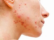 curare l acne dall interno rimedi naturali per l acne secondo il dottor monti non curare l acne dall interno rimedi naturali per l acne secondo il dottor monti non