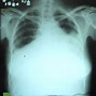 Image result for Pericardial Drain