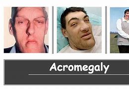 Image result for acromeg�lkco