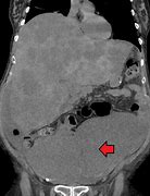 Image result for 10 Cm Tumor in Colon
