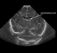 Image result for Bilateral Choroid Plexus Cyst