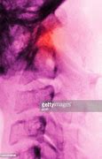 Image result for Open MRI Cervical Spine