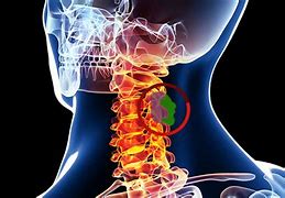 Image result for Tumor On Spinal Cord