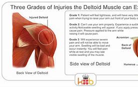 Image result for Shoulder Deltoid Muscle Pain