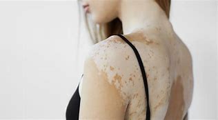 Image result for Vitiligo On White Skin