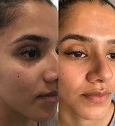 Image result for Saliscylic Acid Before and After
