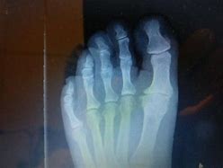 Image result for Foot Knuckles