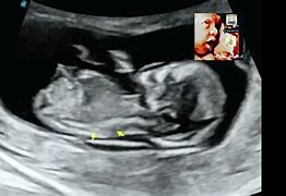 Image result for Sirenomelia Fetal Ultrasound