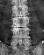 Image result for AP Lumbar Spine