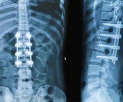 Image result for Spinal Fusion Failure