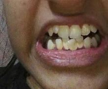 Image result for Cricket Yellow Teeth