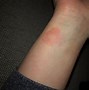 Image result for Apple Watch Band Allergy