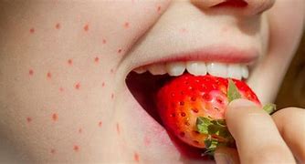 Image result for Allergic Reaction to Strawberries Rash