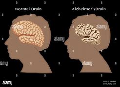 Image result for Alzheimer's Brain
