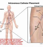 Image result for Femoral Central Venous Catheter