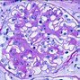 Image result for Renal Hyalinosis