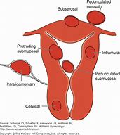 Image result for Uterine Fibroid Classification
