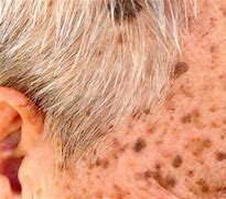 Image result for Almond Oil and Seborrheic Keratosis