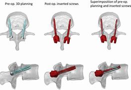 Image result for Picture of an Awl and a Tap in Spine Screw Placement