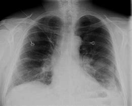 Image result for Thoracic Vent