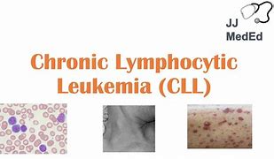 Image result for Symptoms of CLL Leukemia