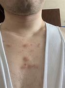Image result for Lump Under Skin On Chest