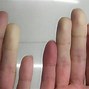 Image result for Vibration Injury Hand