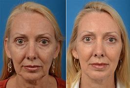 Image result for Eyelid Lift