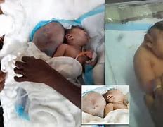 Image result for Anencephaly Baby Survives