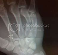 Image result for Urijah Faber Broken Hands