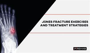 Image result for Treating a Jones Fracture