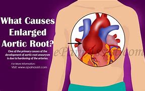 Image result for Dilated Aortic Root