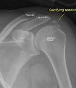 Image result for calcificat