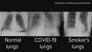 Image result for Covid Lungs
