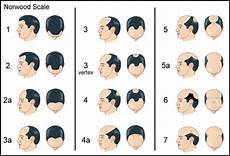 Men S Hair Loss Treatments And Solutions With Pictures