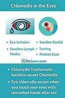 Image result for Chlamydia Eye Infection Symptoms