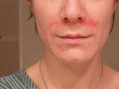 Image result for Dermatitis Rash On Face