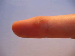 Image result for Molluscum Bumps