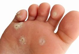 Image result for Wart Between Toes
