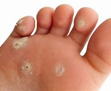Image result for Plantar Wart Core