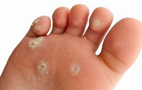 Image result for Plantar Wart Coming Out