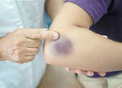 Image result for hematoma