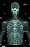 Image result for X-ray of Ribs