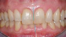 piombatura denti gallery smilife piombatura denti gallery smilife