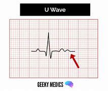 Image result for EKG U Wave Causes