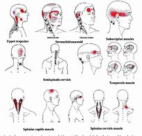 Image result for Tension Headache Neck Pain