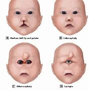 Image result for Trisomy 13 Cyclopia