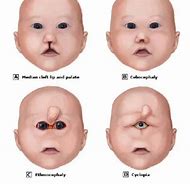 Image result for Cyclopia Real